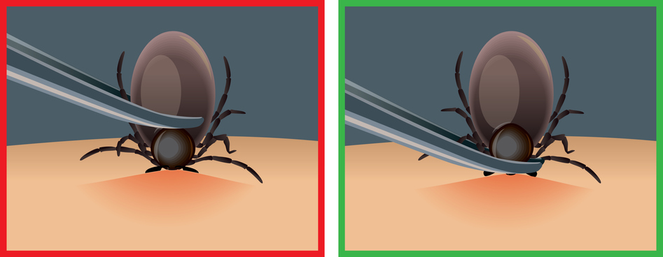 removing tick